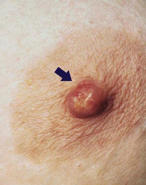 Νόσος του Paget του στήθους. Μια προσωπική ιστορία του καρκίνου του μαστού.