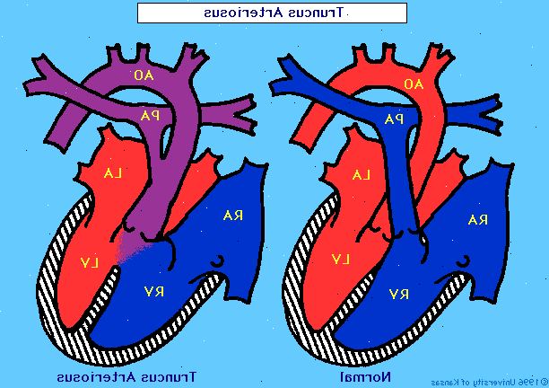 Κοινό αρτηριακό κορμό. Κανονική ανάπτυξη της καρδιάς.