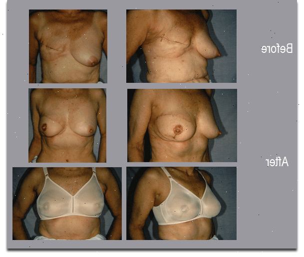 Η ανάπλαση του μαστού με τη χειρουργική επέμβαση πτερύγιο. Μίσχου χειρουργική επέμβαση πτερύγιο.