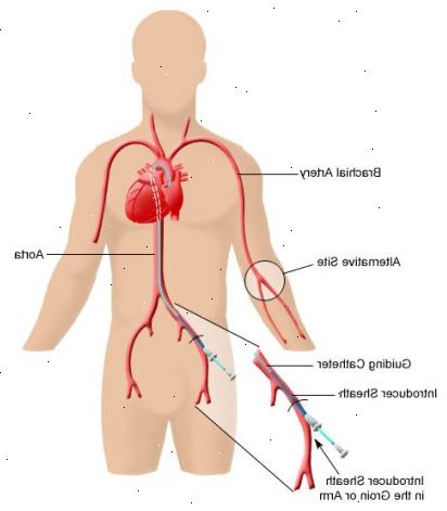 Το κλείσιμο των οπών στην καρδιά και τον καθορισμό άλλες συγγενείς ανωμαλίες. Επιδιορθώστε ή αντικαταστήστε τις βαλβίδες της καρδιάς.