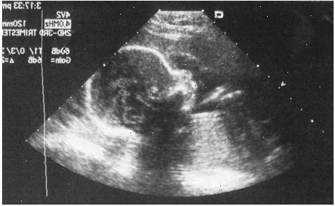 Εμβρύου με υπερήχους. Επιβεβαιώστε την εγκυμοσύνη και τη θέση του.