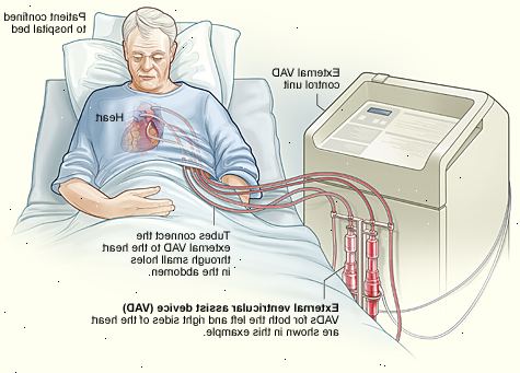 Συσκευές κοιλιακής υποβοήθησης (VADs). Είσαι σε αναμονή για μεταμόσχευση καρδιάς.