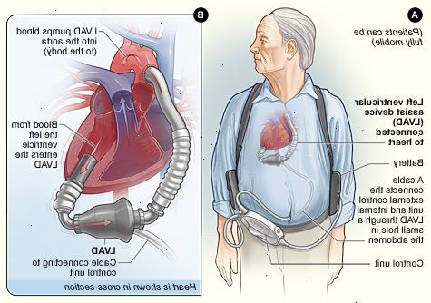 Λειτουργία της καρδιάς σας μπορεί να γίνει κανονικά και πάλι. Δεν είστε ένας καλός υποψήφιος για μεταμόσχευση καρδιάς.