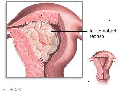 Ορμονική θεραπεία για τον καρκίνο του μαστού. Tamoxifen.