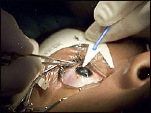 LASIK χειρουργική επέμβαση ματιών. Μυωπία (μυωπία).