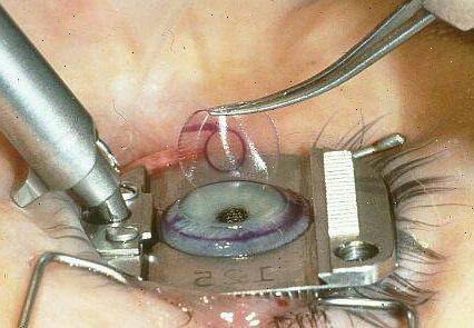 LASIK χειρουργική επέμβαση ματιών. Υποδιόρθωση, υπερδιόρθωση ή αστιγματισμό.