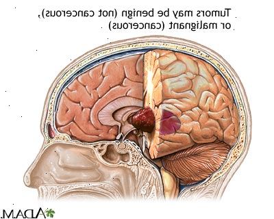 Όγκων του εγκεφάλου. Οι όγκοι του εγκεφάλου που αρχίζουν στον εγκέφαλο.
