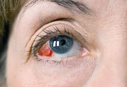 Subconjunctival αιμορραγία (σπασμένα αιμοφόρων αγγείων στο μάτι). Πότε πρέπει να δείτε ένα γιατρό.