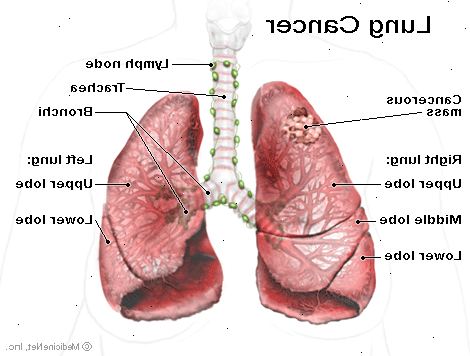 Καρκίνο του πνεύμονα. Πώς το κάπνισμα προκαλεί καρκίνο του πνεύμονα.