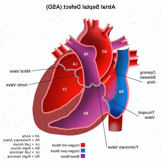 Συγγενείς ανωμαλίες της καρδιάς σε παιδιά. Σοβαρές συγγενείς ανωμαλίες της καρδιάς.